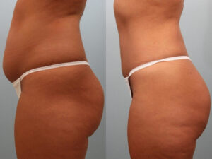 Patient showcasing before and after having Brazilian butt lift (BBL) surgery.