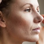 Facial Scars and Acne Scars