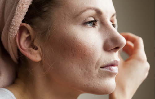 Facial Scars and Acne Scars