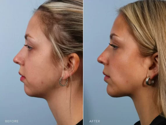 Photo showcasing before and after buccal fat removal plastic surgery