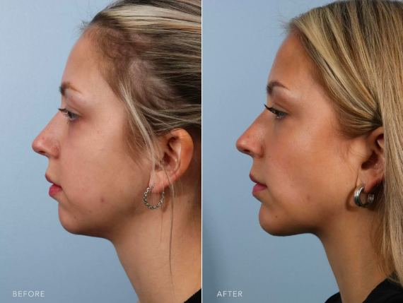 Photo showcasing before and after buccal fat removal plastic surgery