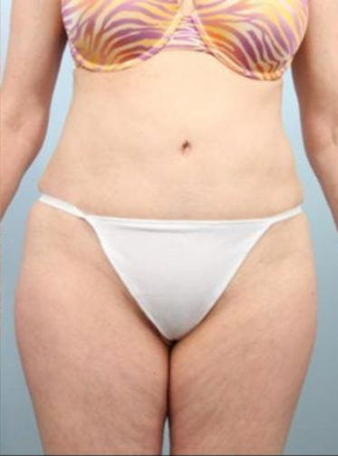 Closeup of the lower body of a female after tummy tuck surgery showing visibly contoured sides and back