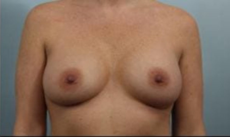 Closeup of a female standing angled with larger breasts after breast augmentation with implants plastic surgery