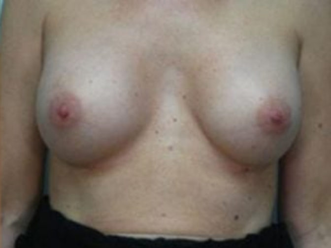 Closeup of a female showing firmer and fuller breasts after breast augmentation with implants plastic surgery