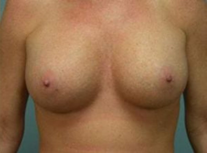 Closeup of a female showing fuller and larger breasts after breast augmentation with implants plastic surgery