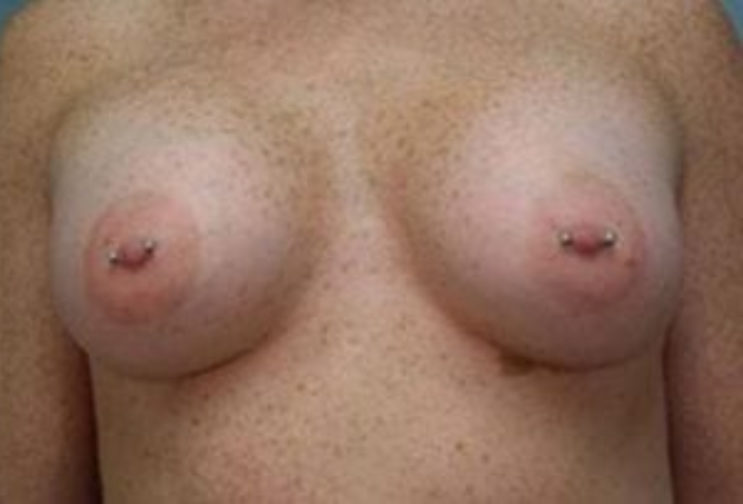 Closeup of a female showing larger breasts after breast augmentation with implants plastic surgery