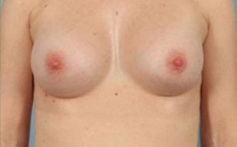 Closeup of a female after breast augmentation surgery showing fullness and contoured breast tissue