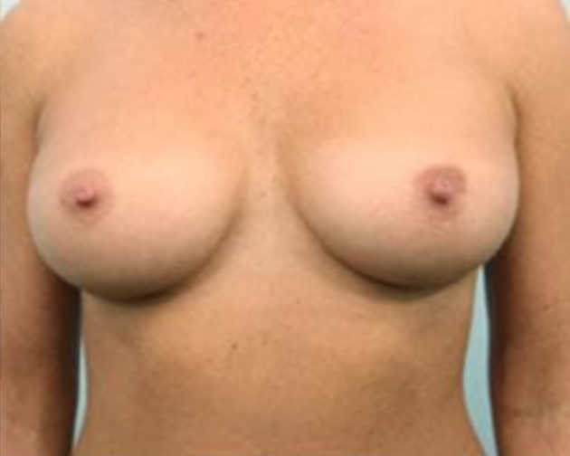 Closeup of a female showing larger breasts with natural results after breast augmentation plastic surgery