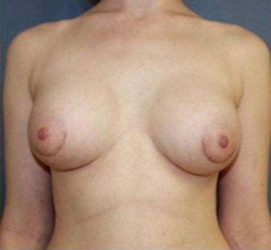 Closeup of a female showing perfectly sized breasts after breast augmentation with implants plastic surgery