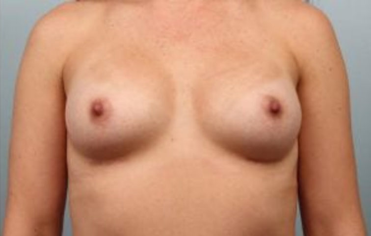 Closeup of a female showing natural-looking large breasts after breast augmentation with implants plastic surgery