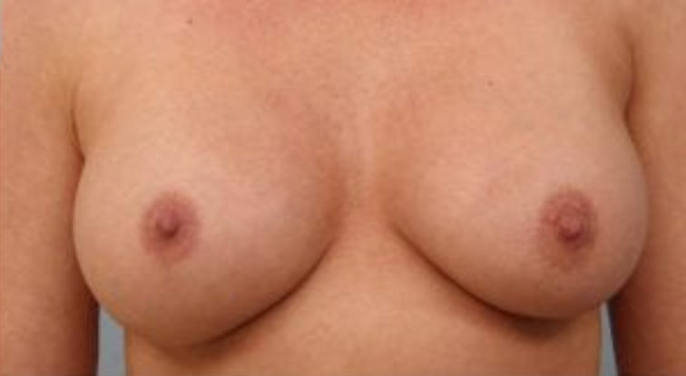 Closeup of a female showing even and full-figured breasts after breast augmentation with implants plastic surgery