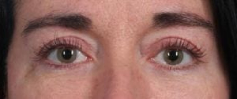 Closeup of a female with black hair with tighter under eye skin for a younger look after a blepharoplasty surgery