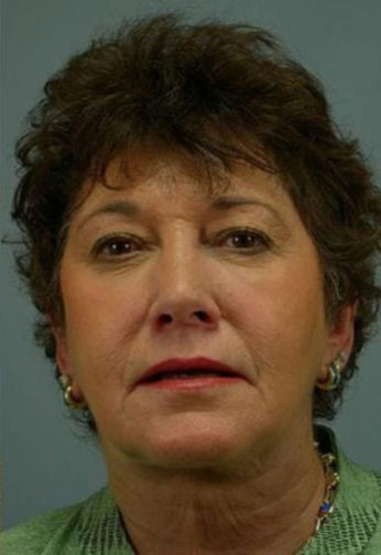 Closeup of a female wearing silver earrings showing stretched skin in her jowls and neck after facial fat transfer surgery