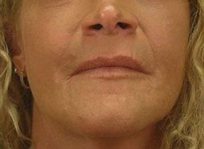 Closeup of a blonde female with tighter skin on her under eyes, jawline, and neck after a facial fat transfer surgery