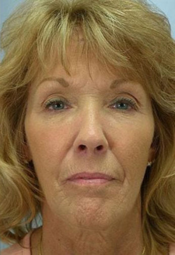 Closeup photo of a female with facial skin that is tighter and firmer after having facial fat transfer plastic surgery