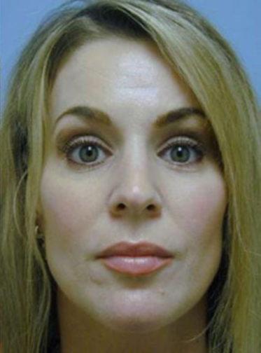 Closeup of a female showing tighter skin on her forehead after endoscopic forehead lift procedure