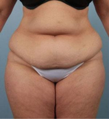 Closeup of a female before tummy tuck surgery showing excess skin and fat along her stomach before tummy tuck surgery