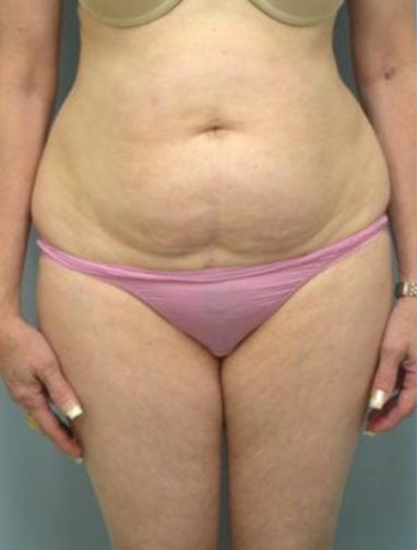 Closeup lower body of a female before tummy tuck surgery with excess skin and wide hips