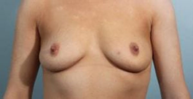 Closeup of a female showing deflated breasts before breast augmentation and implant plastic surgery