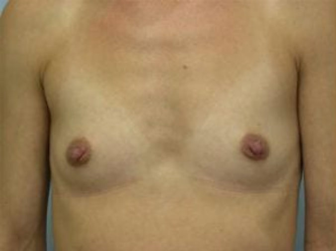 Closeup of a female body showing a flat chest before a breast augmentation with implants procedure