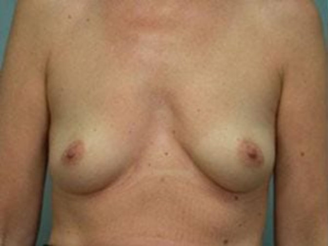 Closeup of a female showing sagging breasts before breast augmentation and implant plastic surgery