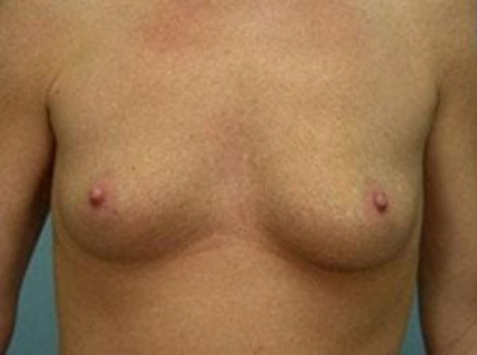 Closeup of a female showing pocket-sized breasts before breast augmentation and implant plastic surgery