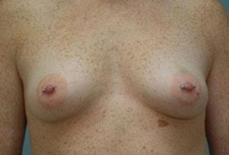 Closeup of a female showing sagging and small breasts before having breast augmentation and implant plastic surgery