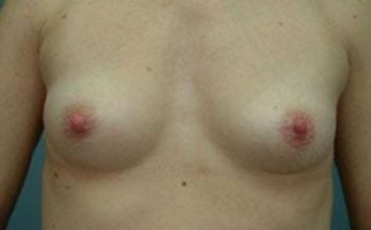Closeup of a female showing small breasts before breast augmentation plastic surgery