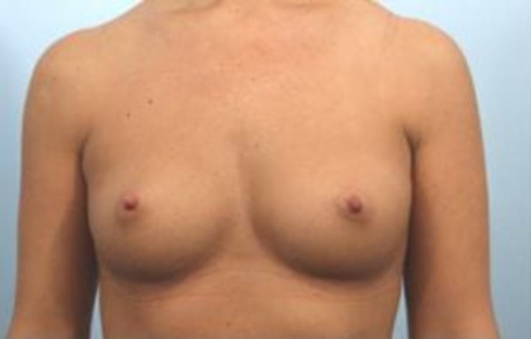 Closeup of a female showing tiny breasts before having breast augmentation and implant plastic surgery