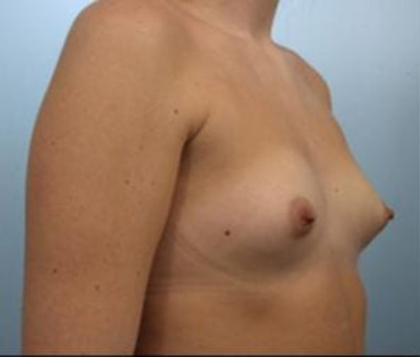 Closeup of a female showing petite breasts before having breast augmentation and implant plastic surgery