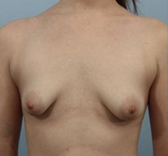 Closeup of a female body showing small breasts before breast augmentation with implants procedure