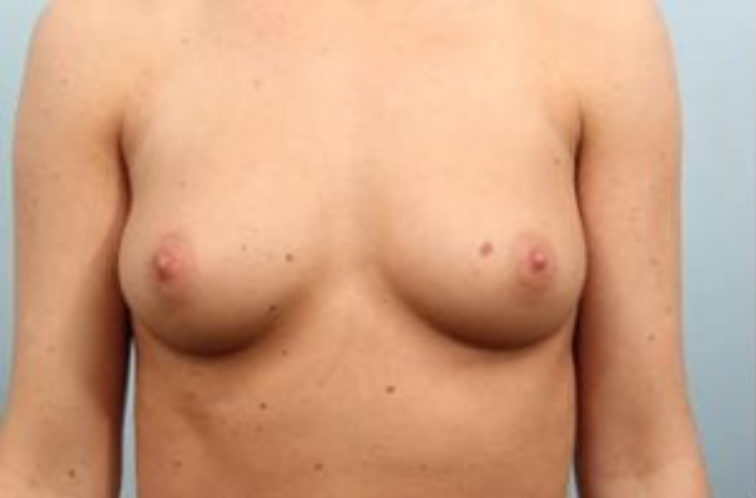 Closeup of a female showing small breasts with minimal contour before a breast augmentation procedure