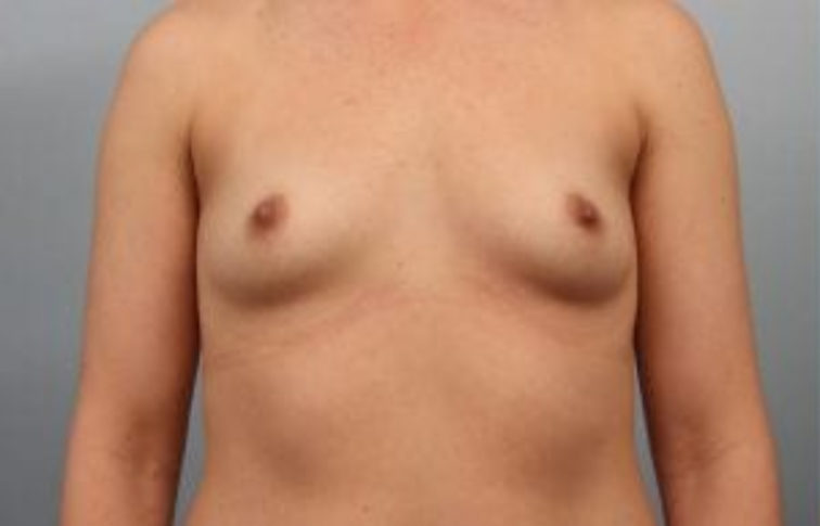 Closeup of a female showing sagging, small breasts before having breast augmentation and implant plastic surgery