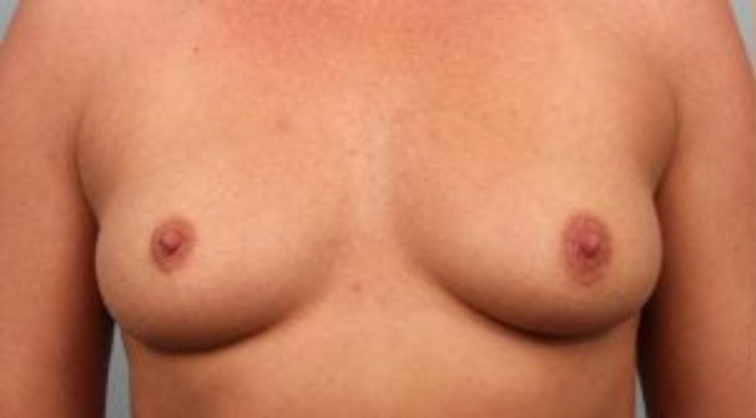Closeup of a female showing unevenly sized breasts before having breast augmentation and implant plastic surgery