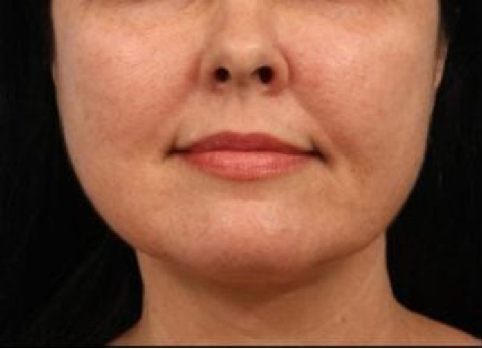 Patient 26207656, Buccal Fat Pad Removal Before & After Photos