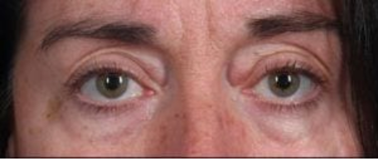 Closeup of a female with black hair showing wrinkled and puffy skin around her eyes before a blepharoplasty surgery