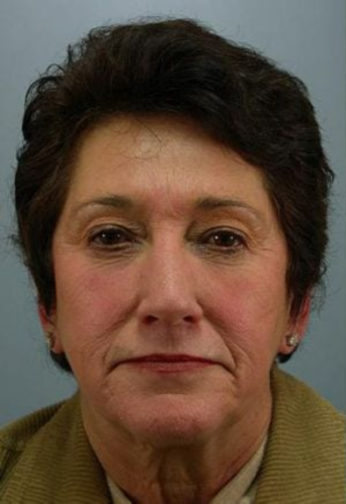 Closeup of a female wearing a green shirt showing evident wrinkles in her face and neck before facial fat transfer