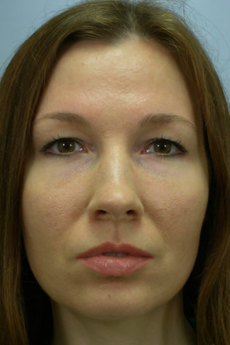 Closeup photo of a female with brown hair showing tighter skin under her eyes after facial fat transfer plastic surgery