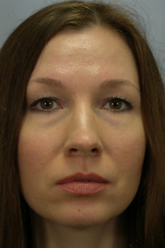 Closeup photo of a female with brown hair showing puffiness under her eyes before facial fat transfer plastic surgery
