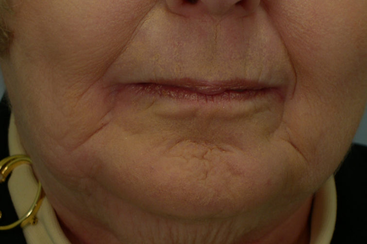 Closeup of a female wearing a yellow shirt after a CO2 laser procedure showing a smooth and youthful apperance