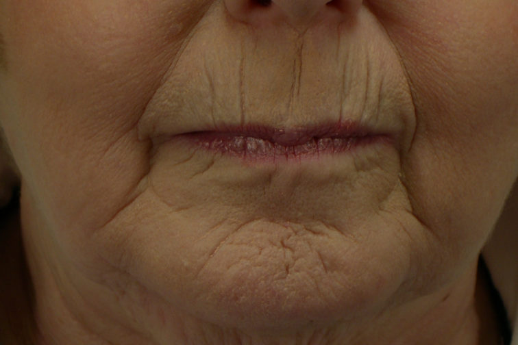 Closeup of a female before CO2 laser surgery showing visible wrinkles around her mouth and chin area