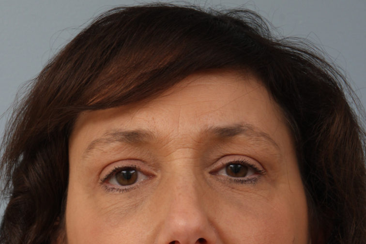 Closeup of a female's front view showing smooth upper eyelids after a brow lift procedure