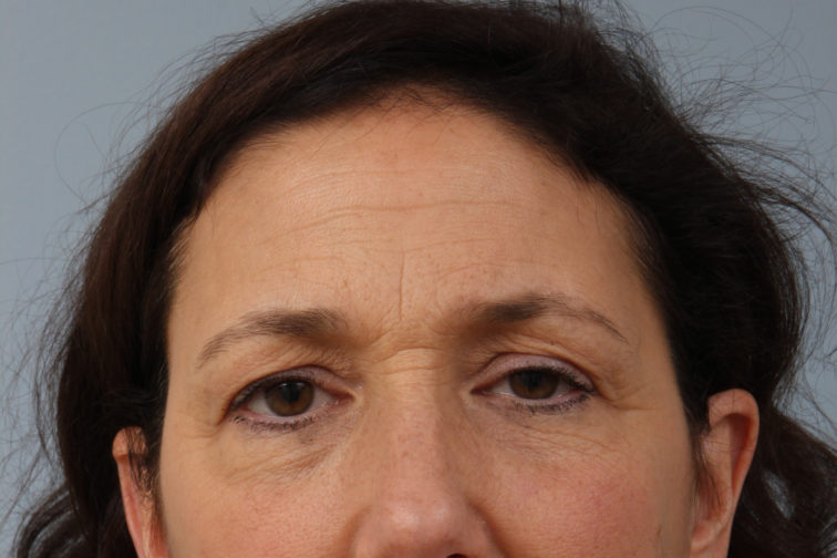 Closeup of a female's front view showing visible eye wrinkles, saggy upper eyelids, before a brow lift procedure