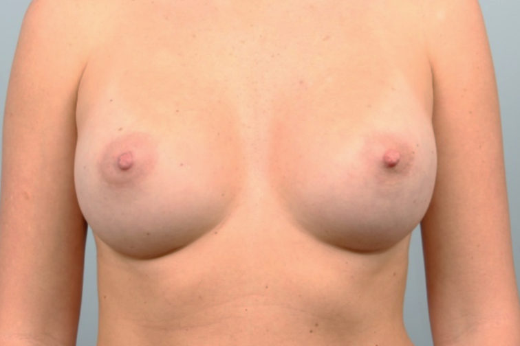 Closeup of a female showing increases volume in her breasts after a breast augmentation plastic surgery