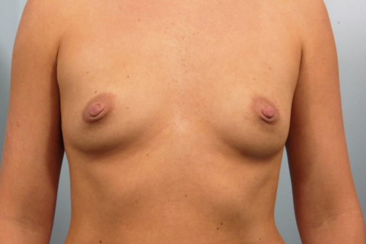 Closeup of a female body showing tiny breasts before breast augmentation with implants procedure