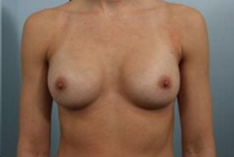 Closeup of a female showing firm and large breasts after breast augmentation with implants plastic surgery