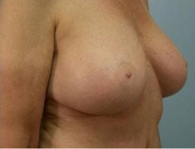 Closeup of a female showing well sculpted breasts after implants were added to her breast tissue
