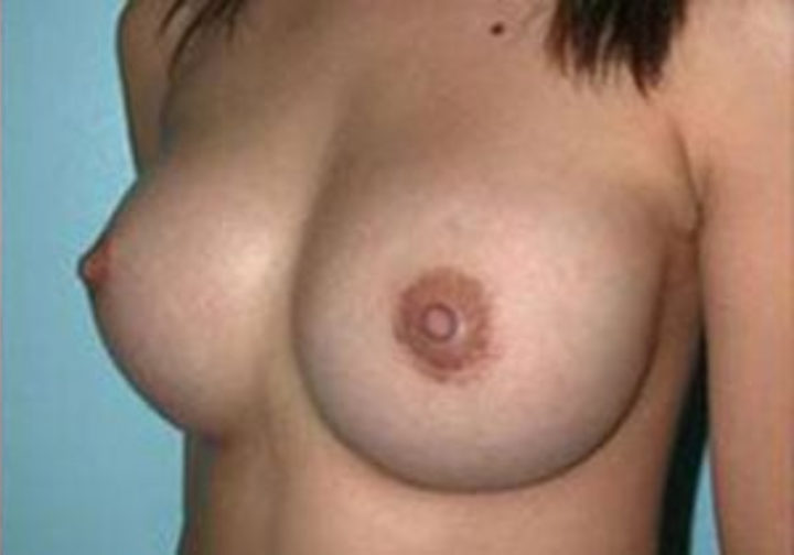 Closeup of a female showing firmer and larger breasts after breast augmentation with implants plastic surgery
