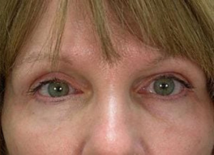 Close-up of an elderly female with well-stretched skin on her upper brow and under-eyes after a blepharoplasty procedure