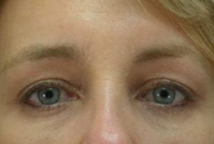 Closeup of a female with tight upper eyelid skin, visible eyelashes, and obvious eye shape after blepharoplasty surgery